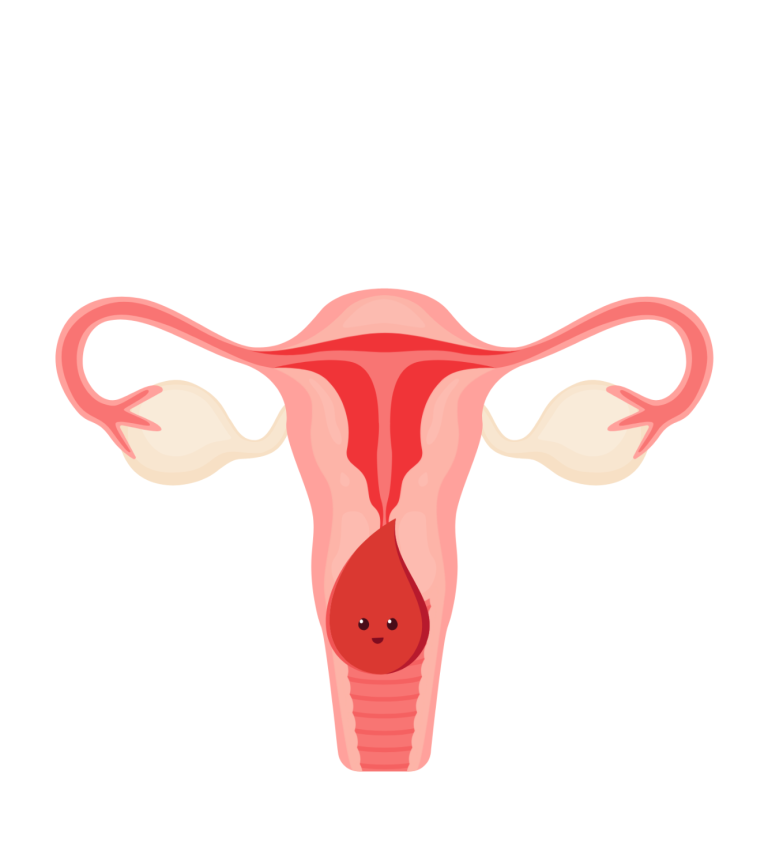 menstruatiepijn endometriose vloeien pcos