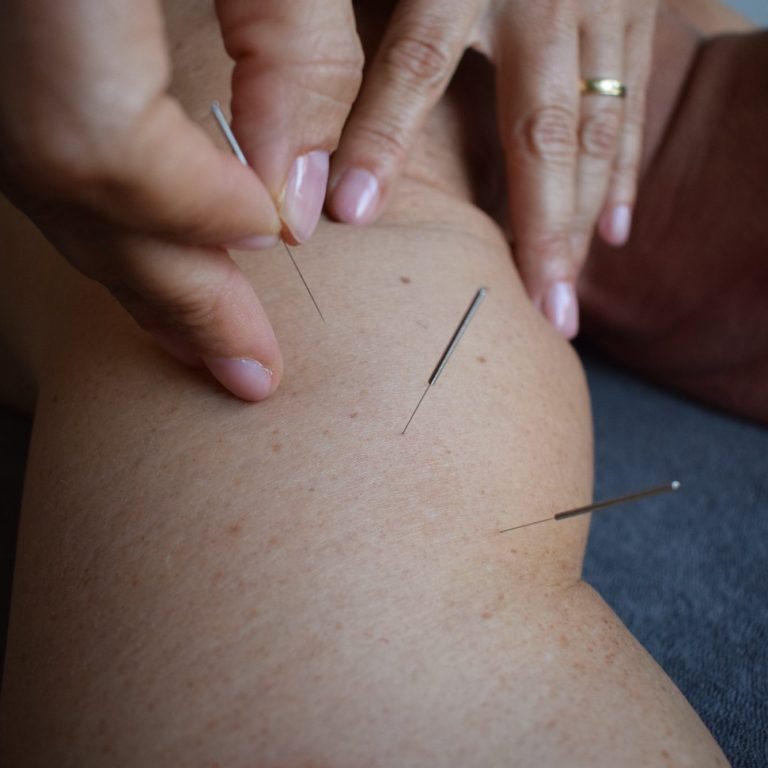 acupunctuur 
